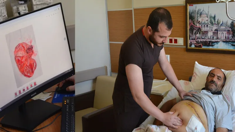 Karın Şişliği Kabusu! 23 cm'lik Kist Şoke Etti